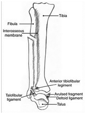 <p><span>MOI:&nbsp; External Rotation of ankle</span></p><p><span>Important: Palpate the proximal lower leg (fibular head), pt will NOT be able to wt bear</span></p><p><span>Maisonneuve Fracture – includes both of the following:</span></p><p><span>Fx at the&nbsp; fibular head</span></p><p><span>Syndesmotic injury - Tibiofibular clear space widened (&gt;5mm)</span></p><p><span>Requires surgical fixation, 2 screws and a long leg cast, unlike simple syndesmotic fracture (just 1 screw)</span></p>