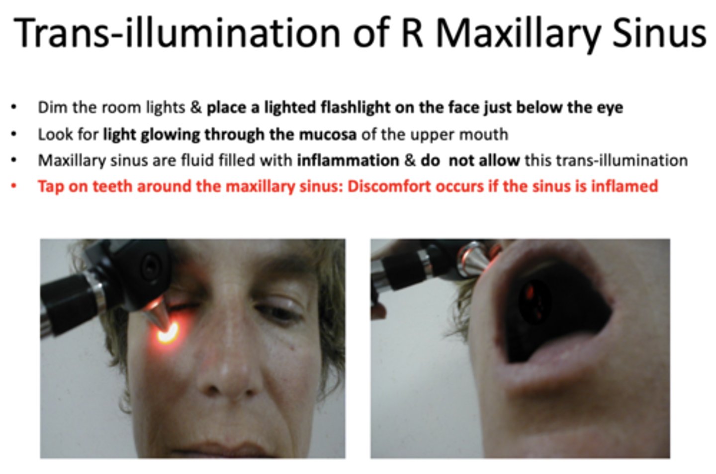 <p>inflamed maxillary sinuses</p>