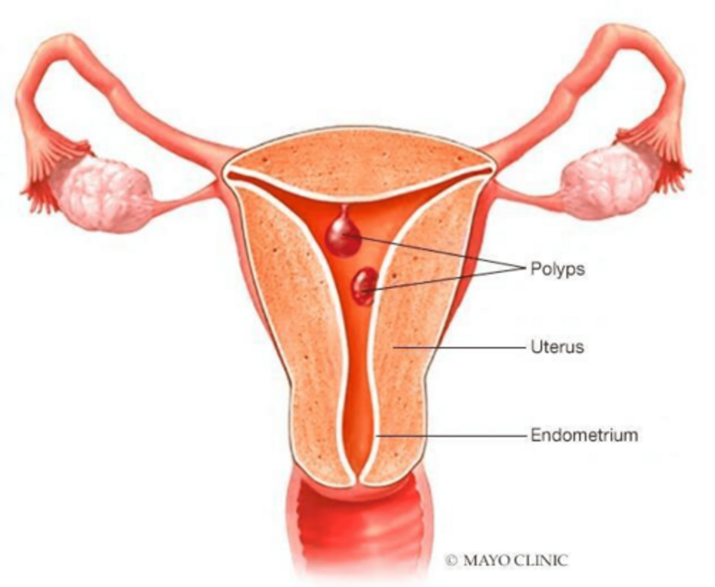 <p>Benign overgrowths of endometrial glands and stroma that form focal lesions in the uterine cavity.</p>