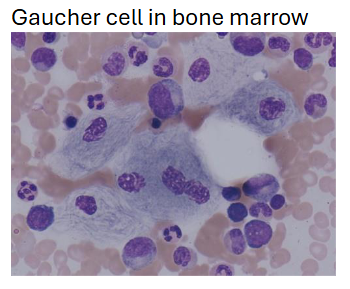 <ul><li><p><span>Found in spleen, marrow, liver, lymph nodes; seen most easily in thickest part of the smear</span></p></li><li><p><u><span>Cytoplasm appears wrinkled liked crumpled tissue paper</span></u></p></li><li><p><span>BM exam alone insufficient for confirming diagnosis since the cells may be present in other disorders</span></p></li><li><p><u><span>Cytochemistry</span></u><span>: PAS, Oil Red O, Iron, and Sudan Black B are positive; </span><strong><span>Acid Phosphatase is very positive</span></strong><span> (tartrate-resistant fraction is what is increased)</span></p></li></ul><p></p>