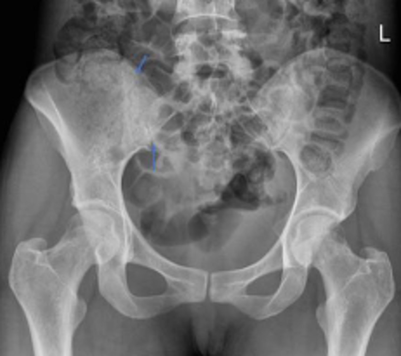 <p>What joint space are the arrows pointing to?</p>