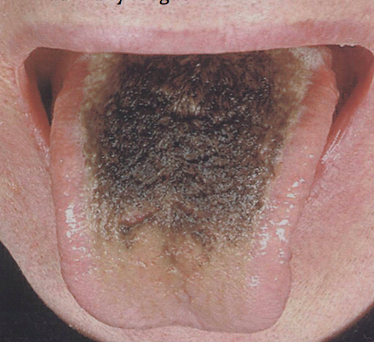 <p>Elongation of the filiform papillae</p><p>Heavy smoking, antibiotic therapy, poor oral hygiene etc.</p>