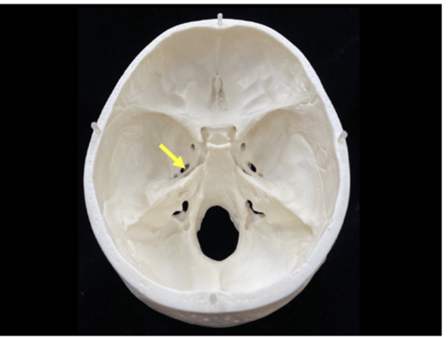 <p>name the bone and bone feature</p>