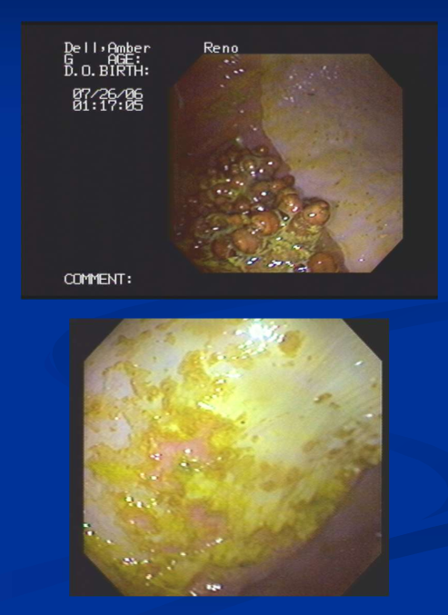 <p>endoscopic appearance of gastric erosion and ulceration </p>