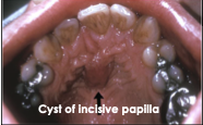 <p>Where do cysts of the incisive papilla occur?</p>