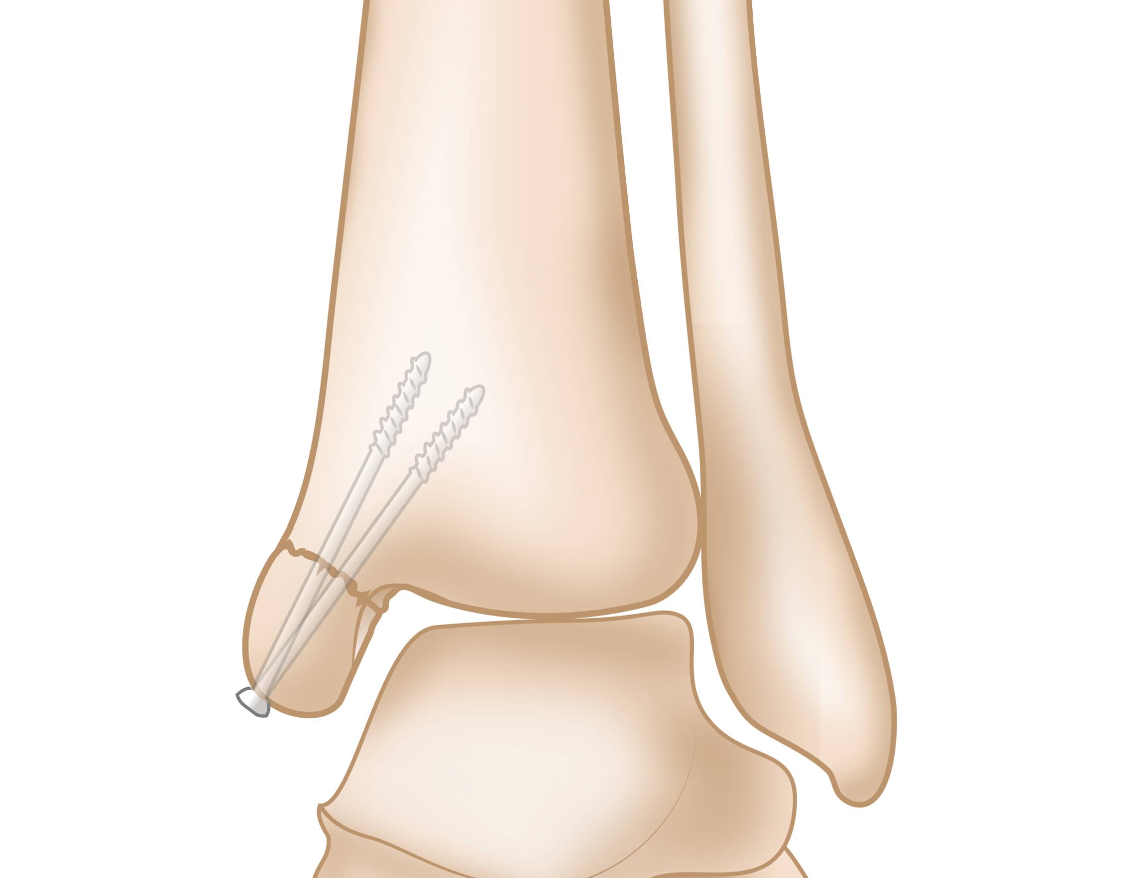 <p>point at the end of tibia</p>