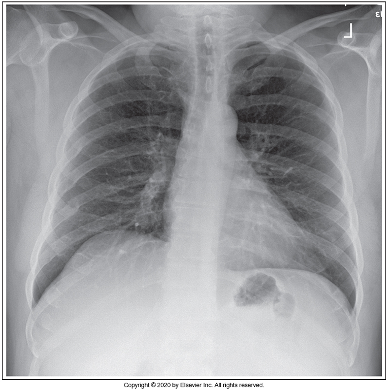 <p>Identify the main problem of the image below (PA chest)</p><p>Patient is tilted anteriorly.</p><p></p><p>Patient is rotated.</p><p>&nbsp;</p><p>Image taken on expiration.</p><p>&nbsp;</p><p>Patient is tilted posteriorly.</p>