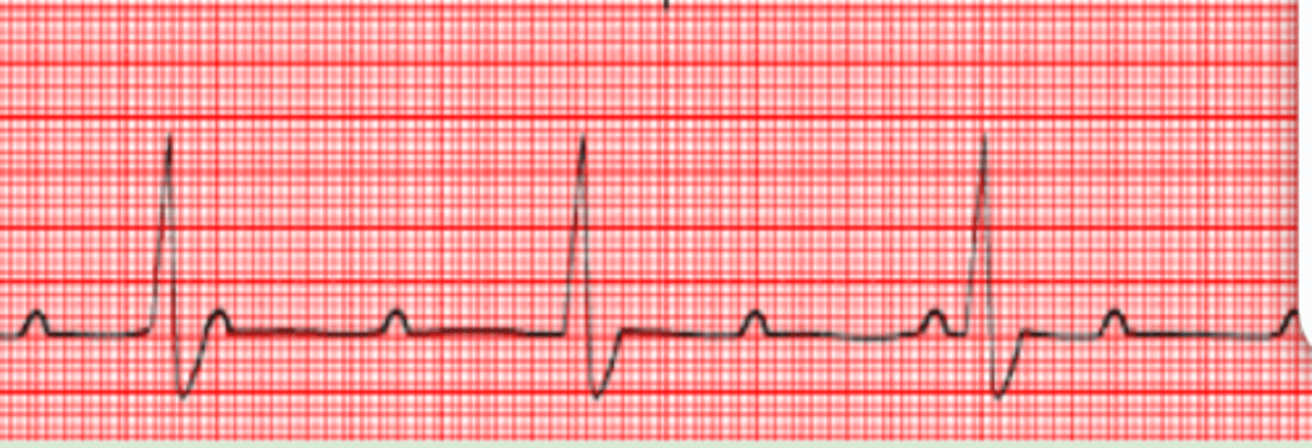 <p>Sinus beats are independent from the beat originating in the AV node or ventricle</p><p>-There will be zero relation of P waves to the QRS complex</p>
