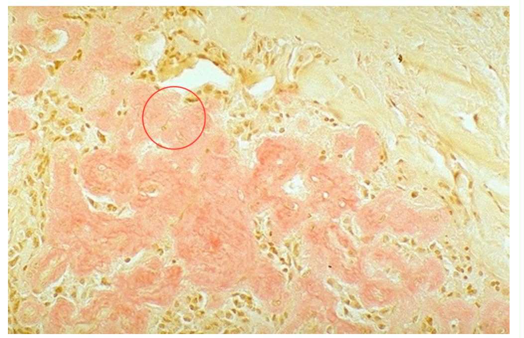 <p>The Congo Red Stain reveals amorphous orange-red deposits of ______. Identify intracellular accumulations.</p>