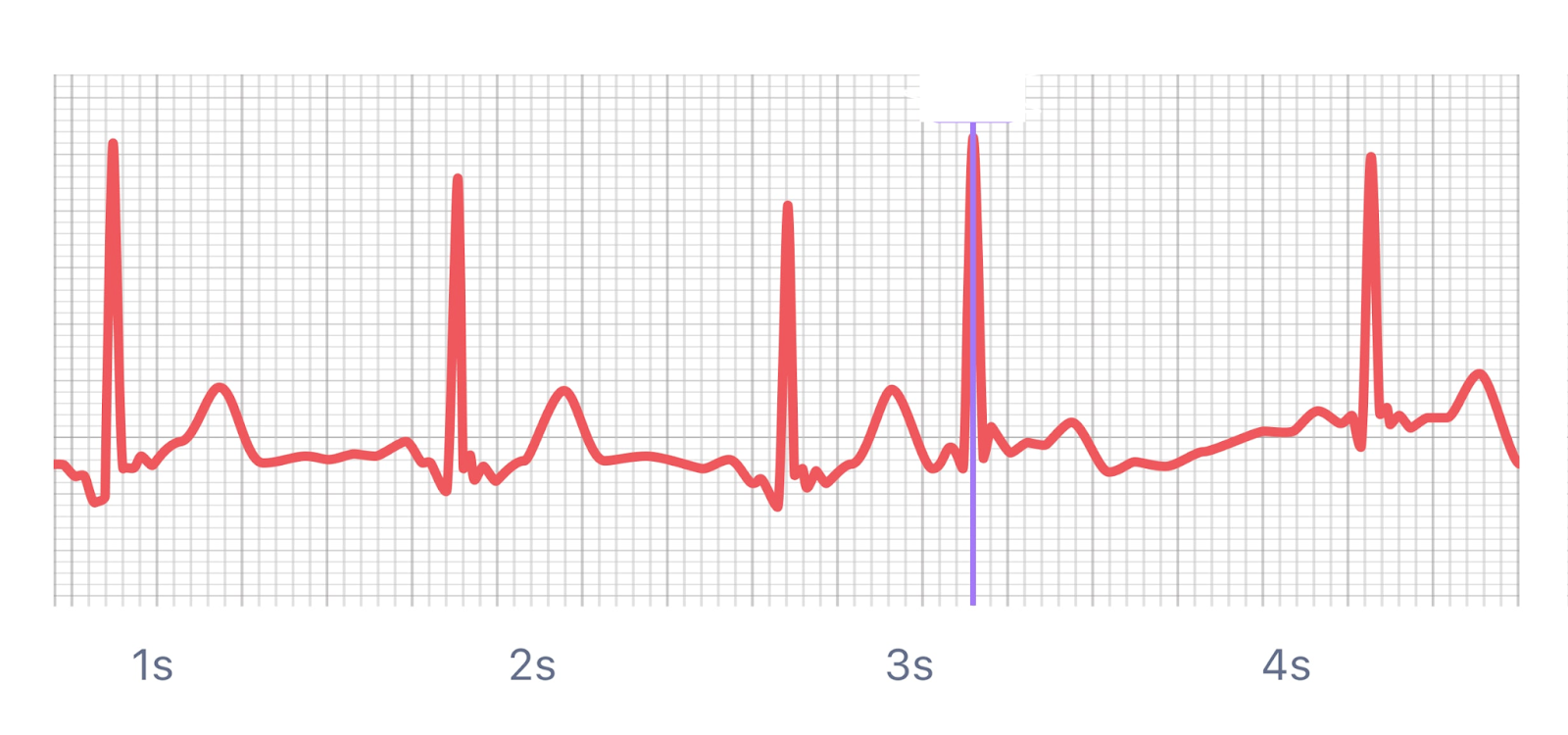 <p>What is this rhythm?</p>