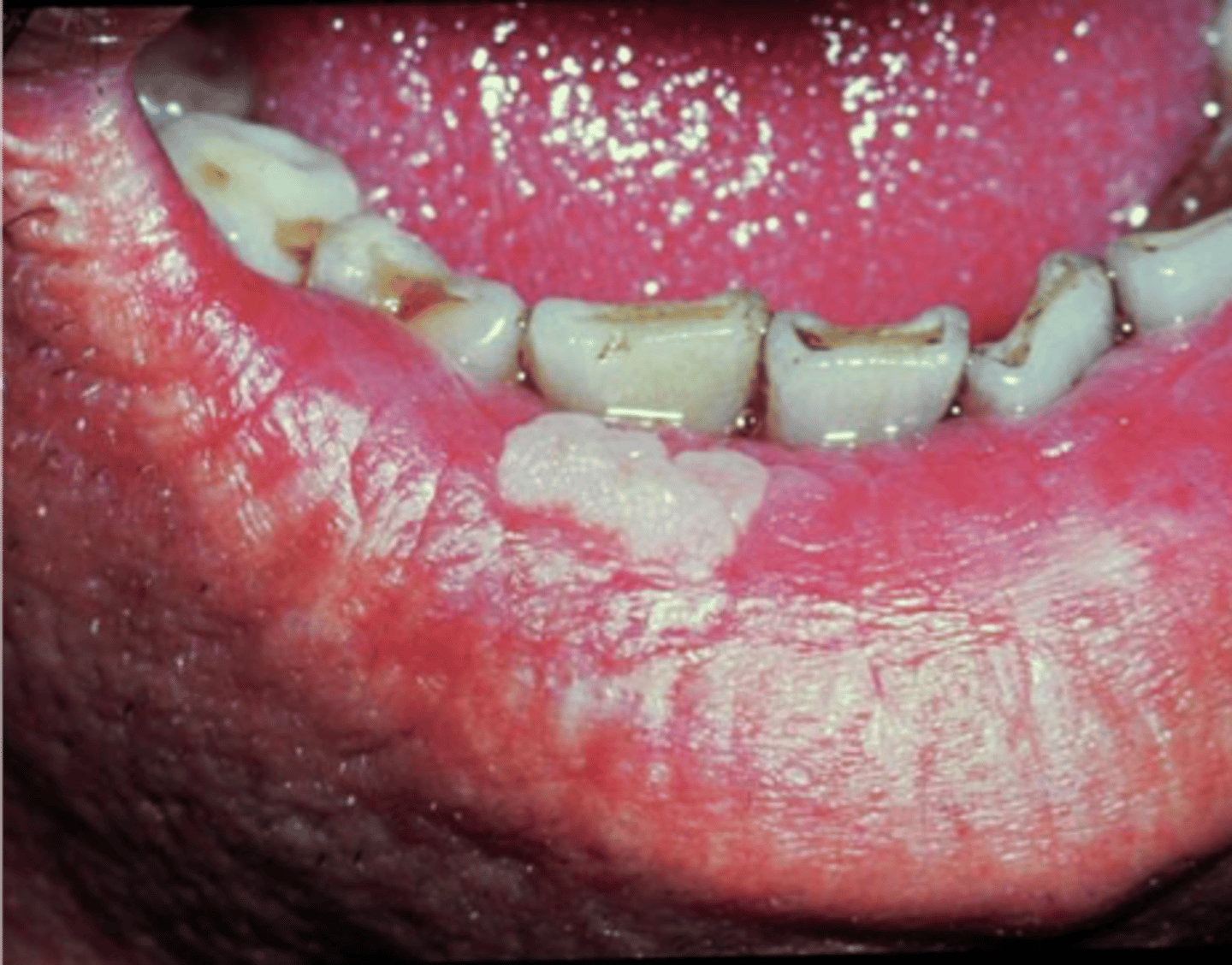 <p>verruca vulgaris</p>