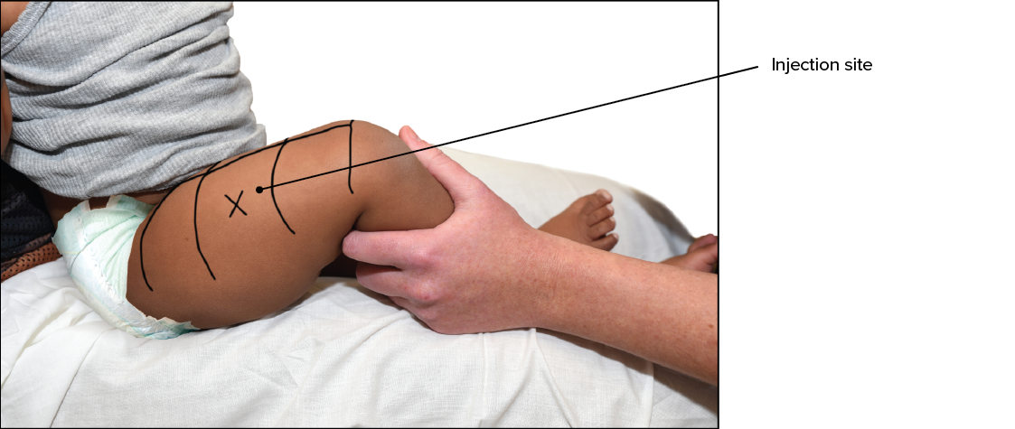 Divide the upper thigh into three equal parts. Locate the middle of these three sections. The injection should go into the outer top portion of this section.