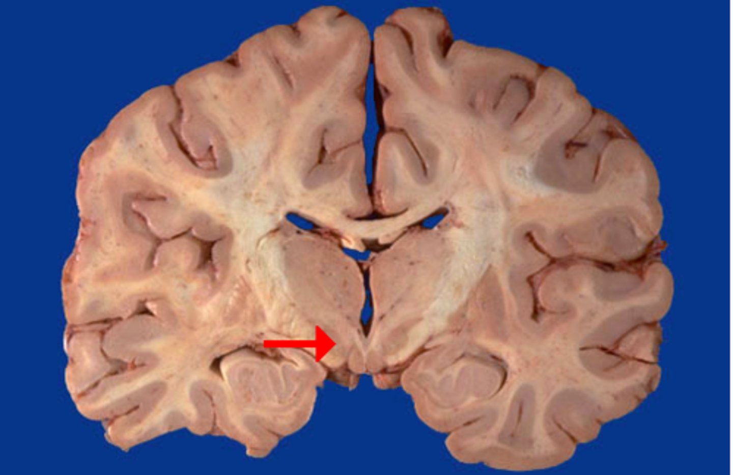 <p>a small nucleus, located ventral to the thalamus, that is part of the basal ganglia</p>