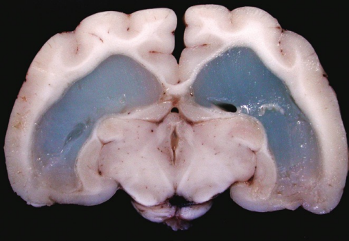 <p>Is the fluid accumulating in the brain ventricles exudate or transudate?</p>