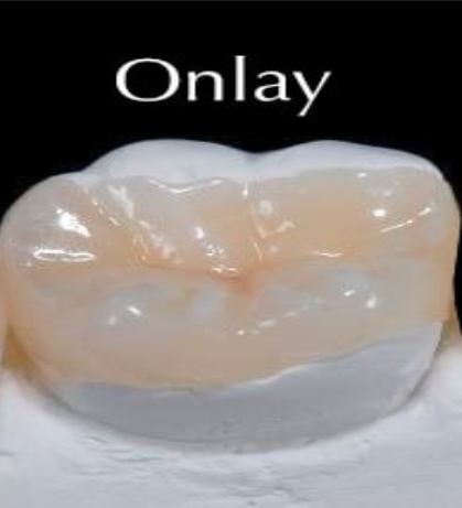 <p>A custom restoration that covers one or more cusps of a tooth, but not the whole tooth.</p>