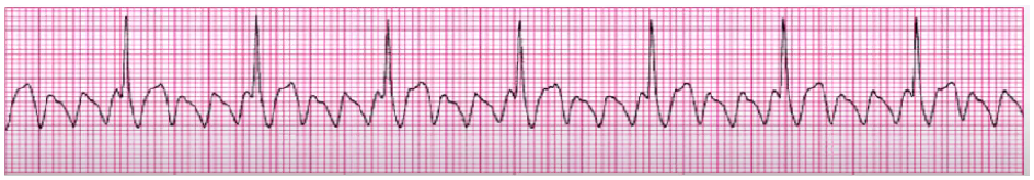 <p>cardioversion for sx and unstable pts</p><p>Digoxin, Ca Channel blockers, amiodarone, BBs</p>