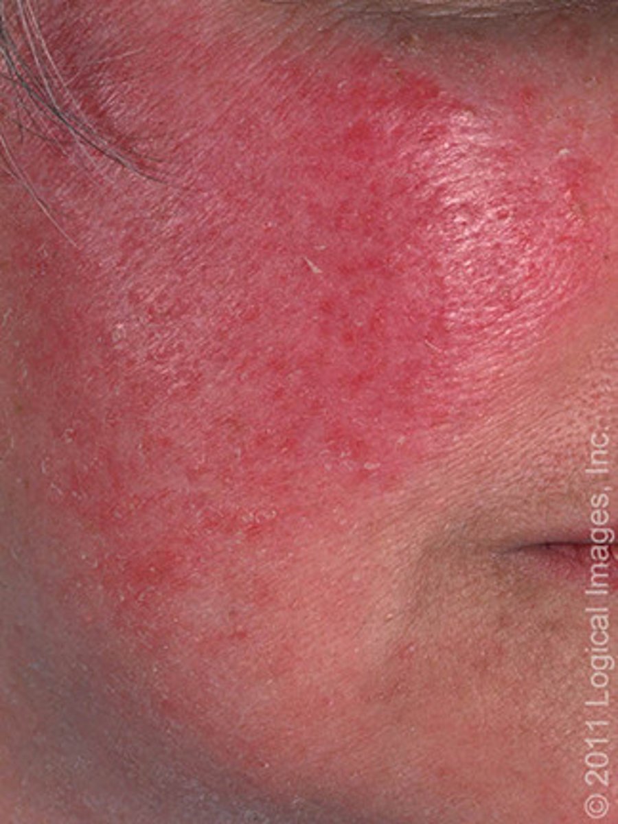 <p>skin infection that causes inflammation, pustule formation, and visible dilated blood vessels (telangiectasia) and facial redness. presents as frequently flushed skin on the face, particularly the nose, forehead, cheeks, and chin.</p>