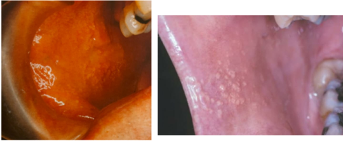 <p>Fordyce granules</p><p>Fordyce granules are yellow clusters of ectopic sebaceous glands that are diagnosed through clinical appearance. Root resorption is identified radiographically when the apex of the tooth appears shortened or blunted. Interproximal dental caries are seen as radiographic radiolucencies. A compound odontoma is initially identified radiographically as a radiopaque area in which tooth structure can be identified.</p>