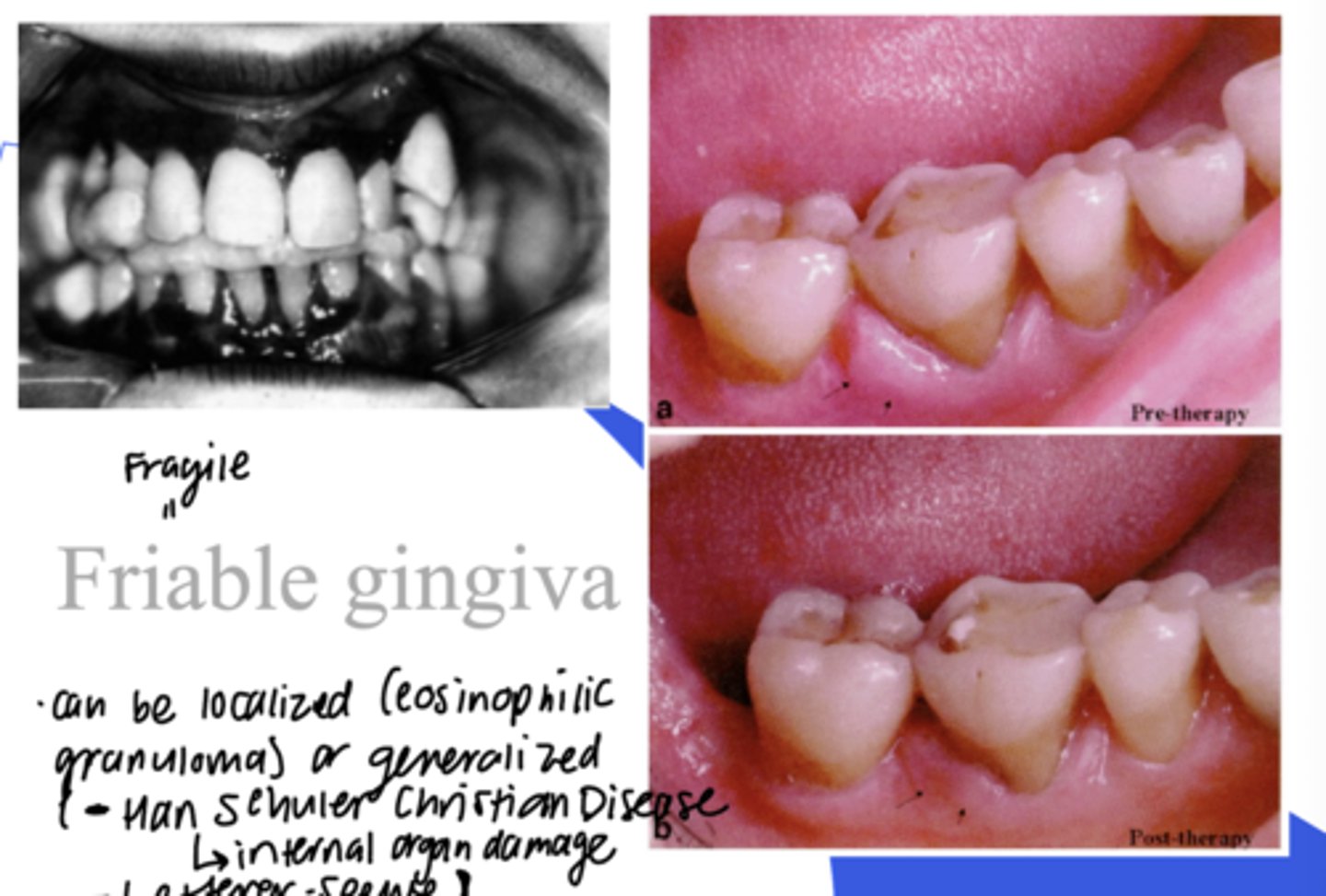 <p>= Fragile gingiva</p><p>- Can be localized (eosinophilic granuloma) or generalized</p>