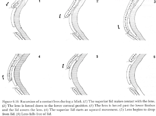 <ol><li><p>Lid attachment (larger >9.5 mm and fit flatter) </p></li><li><p>interpalpebral (smaller <9.5 mm and fit steeper) </p></li></ol><p></p>