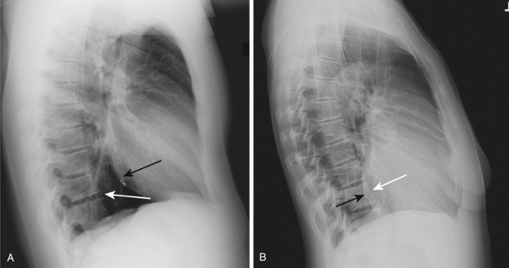 <p>Cardiac Enlargement</p>