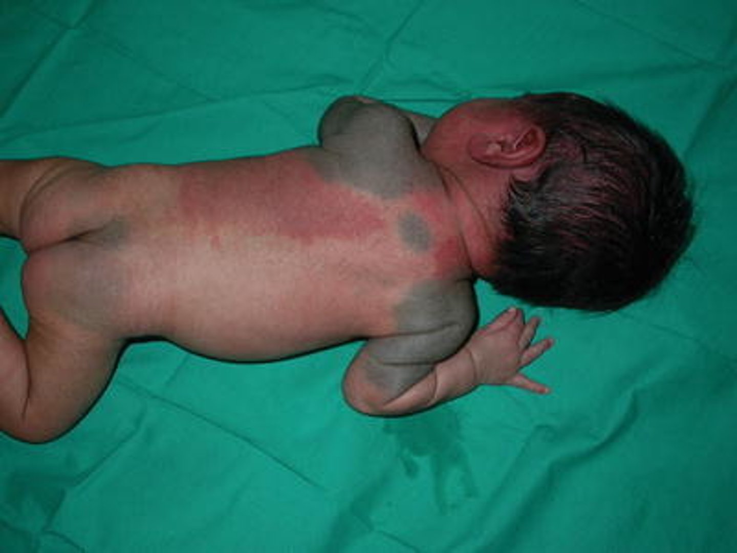 <p>BENIGN blue, green, grey, black discoloration usually on the back and is more common in newborns who are AFRICAN American, HISPANIC American, and ASIAN American.</p>