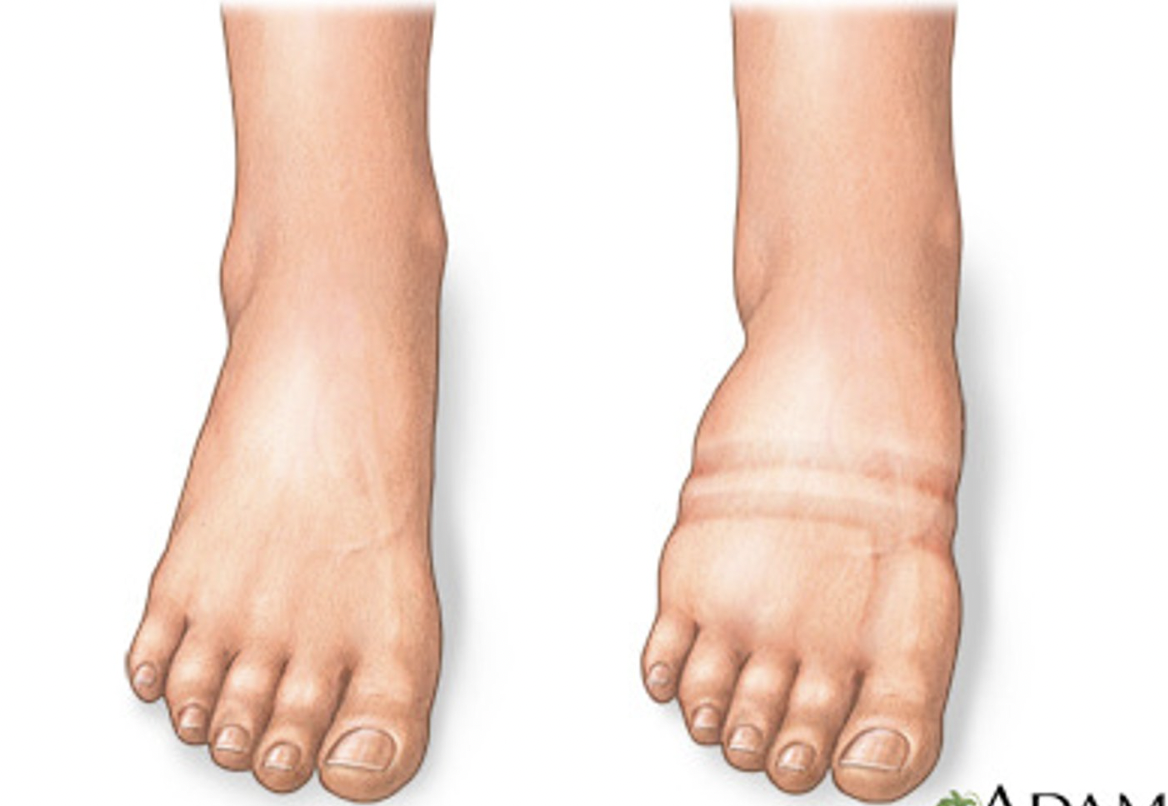 <p>Swelling caused by excess fluid trapped in the body's tissues.</p>