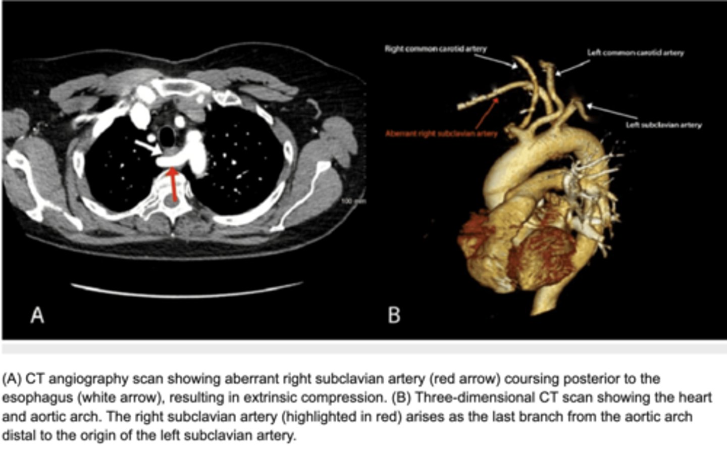 <p>Abnormal origin of the right subclavian artery results in compression of the esophagus -impairment of swallowing</p>