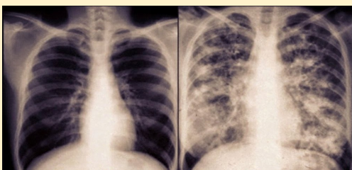 <p>why is the lungs different</p>