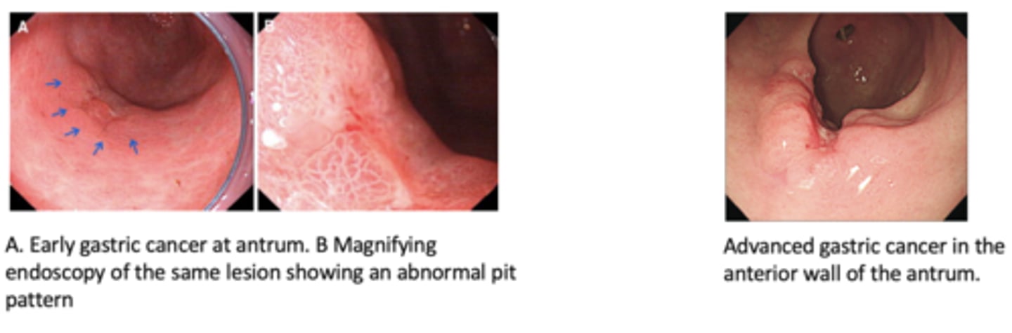 <p>Where are more than half of the total gastric cancer patients from, and explain?</p>