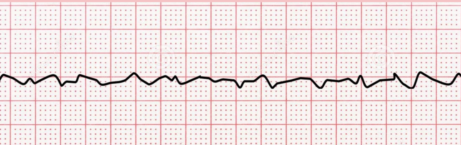 <p>name ECG pattern</p>