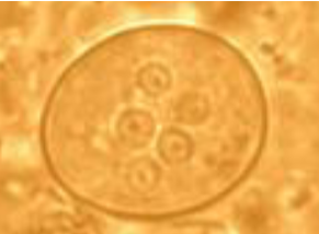 <ul><li><p>Largest amoeba cyst</p><ul><li><p>Up to 35u (15-25u)</p></li><li><p>Easily seen on low power (10x)</p></li></ul></li><li><p>5 or more nuclei</p><ul><li><p>Coarse chromatin ring</p></li><li><p>Eccentric, irregular, karyosome</p></li><li><p><u>Rare chromatoid bars</u></p><ul><li><p><u>Splintered ends</u></p></li></ul></li></ul></li></ul><p></p>