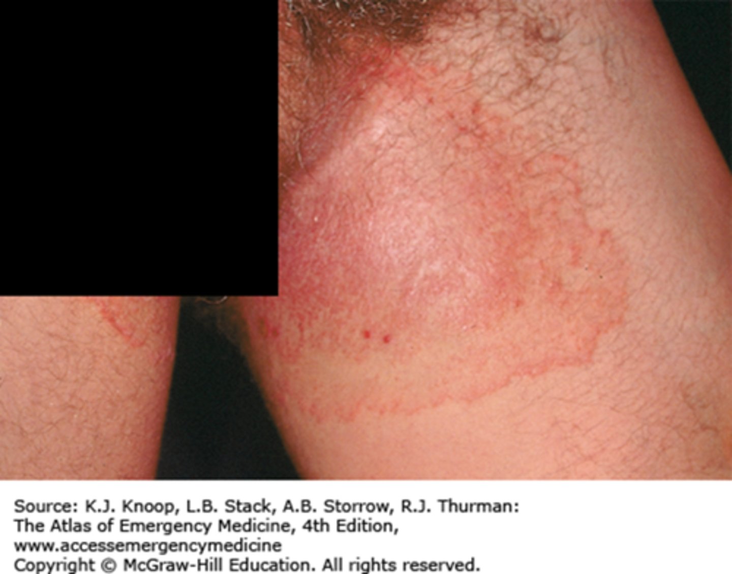 <p>Ringworm, fungal infection of the groin (jock itch)</p>
