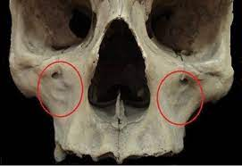 <p>hollow below infraorbital foramen</p>
