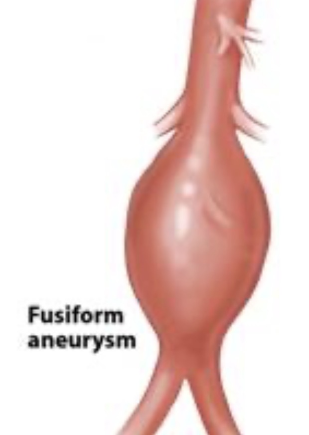 <p>Fusiform Anuerysm </p>