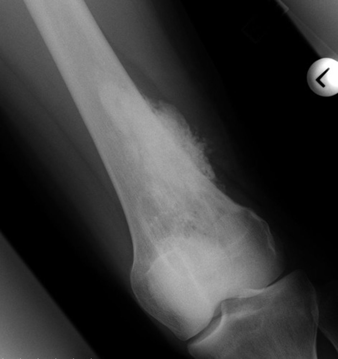 <p>most common primary bone malignancy, adolescents, tumor arising from osteoblastic connective tissue</p>
