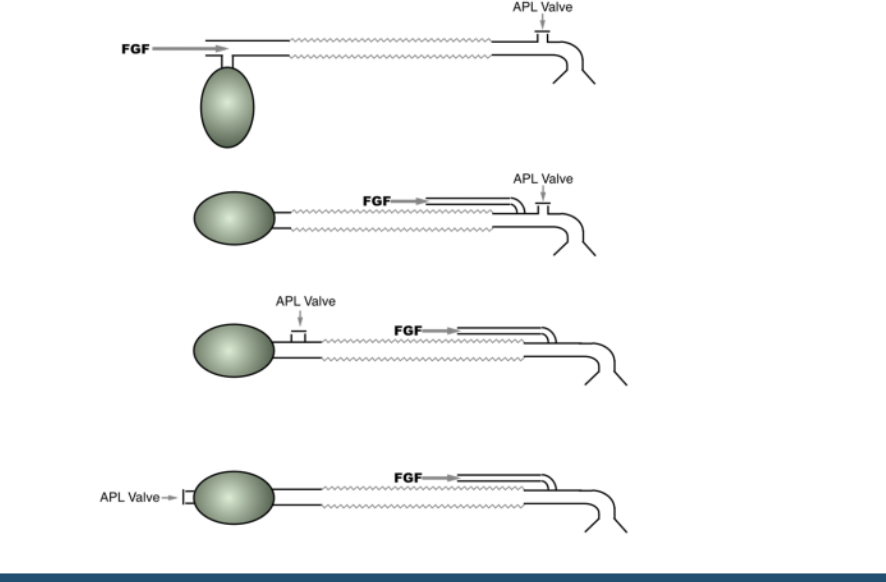 <p>A patinet is receiving controlled ventilation with a fresh gas flow of 5L/min. Click on the cuir tthat is MOST likely to cause hypercarbia</p>