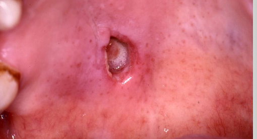 <p>What are the clinical stages of necrotizing sialometaplasia?</p>