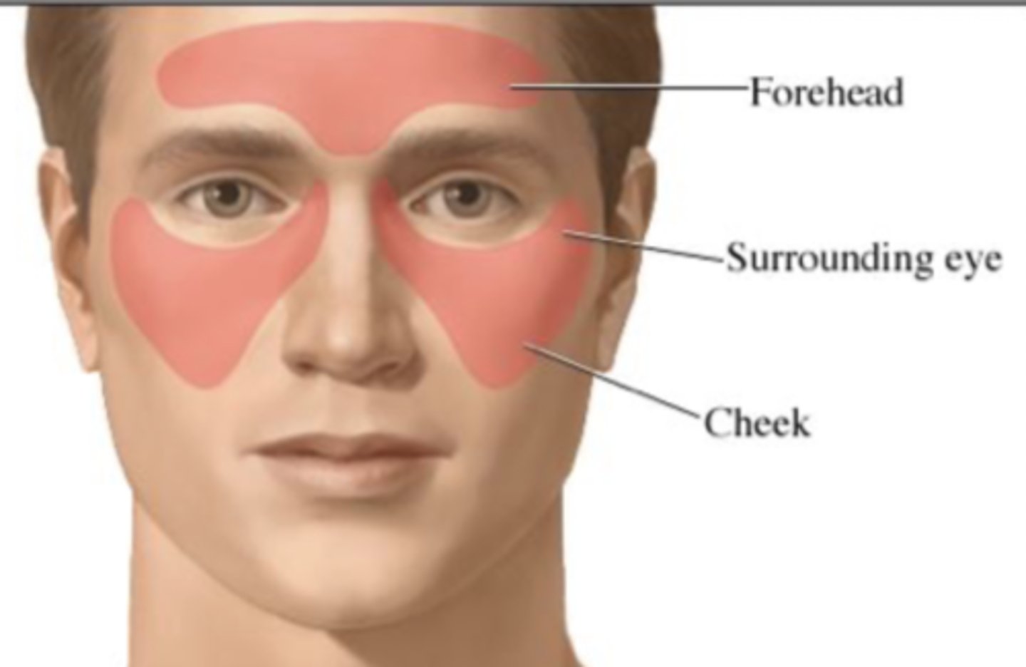 <p>-character = deep, constant, throbbing pain; pressure-like pain in one specific area of the face or head (e.g. behind eyes); face tender to touch</p><p>-onset = occurs with or after a cold or acute sinusitis, or acute febrile illness with purulent discharge from the nose</p><p>-location = may occur in one area of the face or along eyebrow ridge and below the cheek bone</p><p>-duration = lasts until associated condition is improved</p><p>-severity = may be moderately severe, not debilitating</p><p>-pattern = pain worse with sudden movements of the head, bending forward, lying down; in the morning, or sudden temperature changes</p><p>-associated factors = other symptoms of sinusitis, such as nasal drainage and congestion, fever and foul-smelling breath. May be confused with tension headaches and migraines.</p>