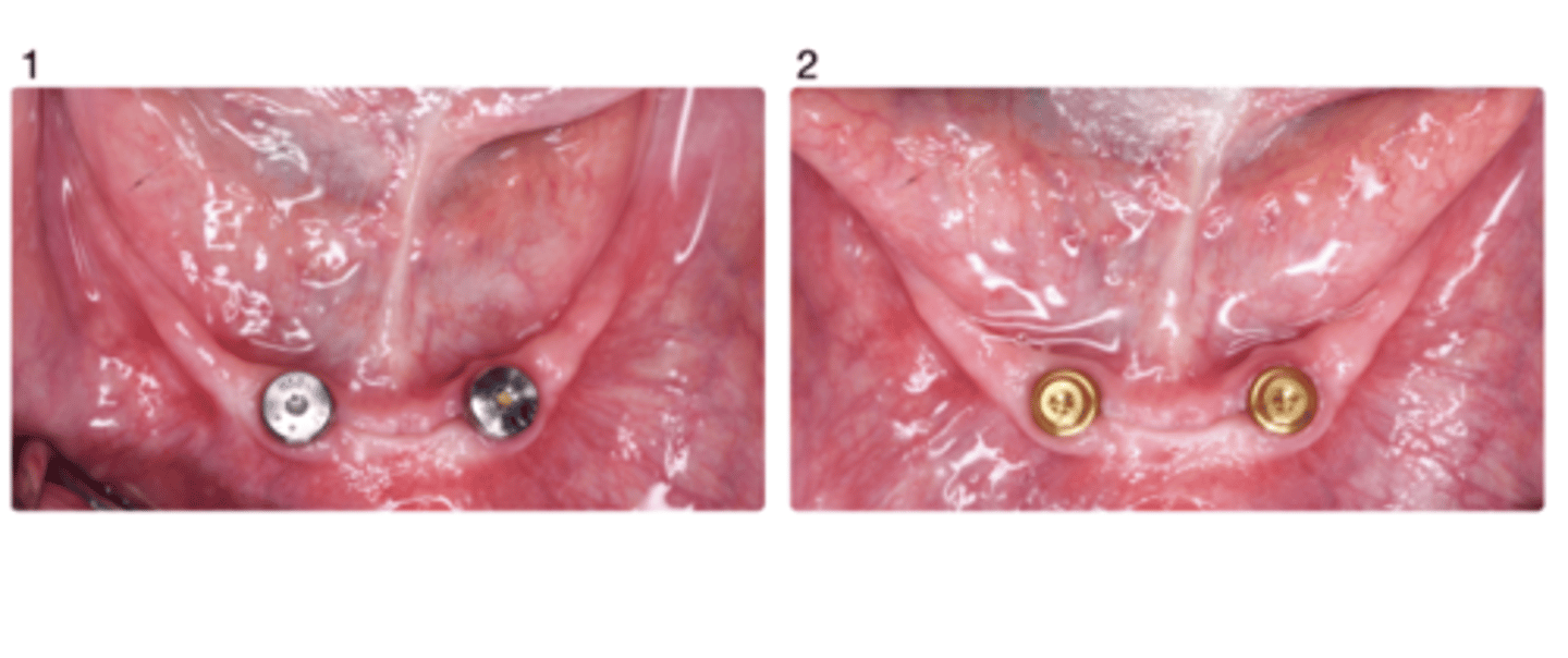 <p>You already fabricate acceptable complete denture before implant planning and the surgeon decided implant locations based on the denture. Based on provided picture bellow, you saw the patient situation 1 in DDS implant clinic after the surgeon confirm the implants can be loaded. Your plan to use the current denture as a definitive implant assisted complete denture. At next appointment, you placed abutments on the implant (Situation 2) to delivery implant assisted complete denture. Between 1 and 2, what do you need to do ? (Select all).</p><p>a. Measure peri-implant mucosa thickness</p><p>b. Laboratory reline of the denture</p><p>c. Final impression</p><p>d. Pick up procedure of housing</p><p>e. preliminary impression</p>