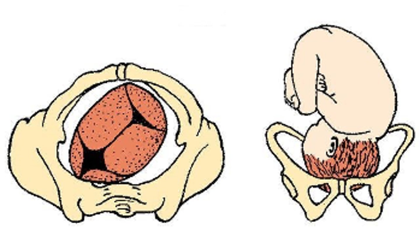 <p>b. Cephalic presentation, Left Occiput anterior (LOA)</p>