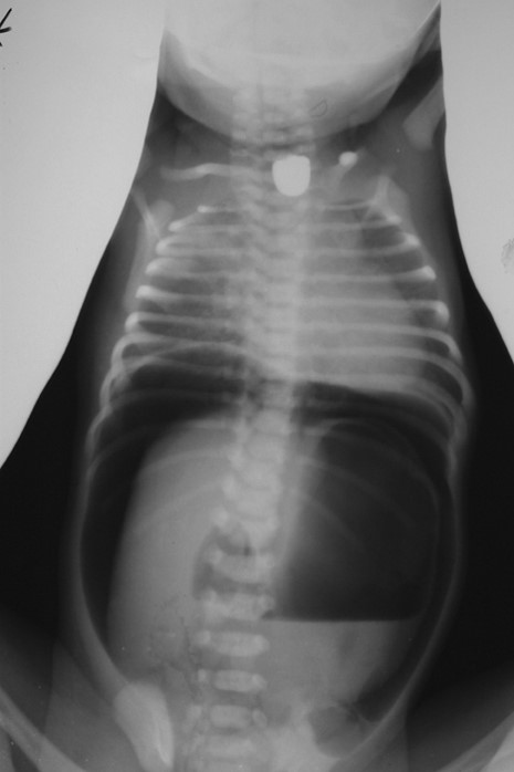 <p>What is the key plain-film finding in esophageal atresia?</p>