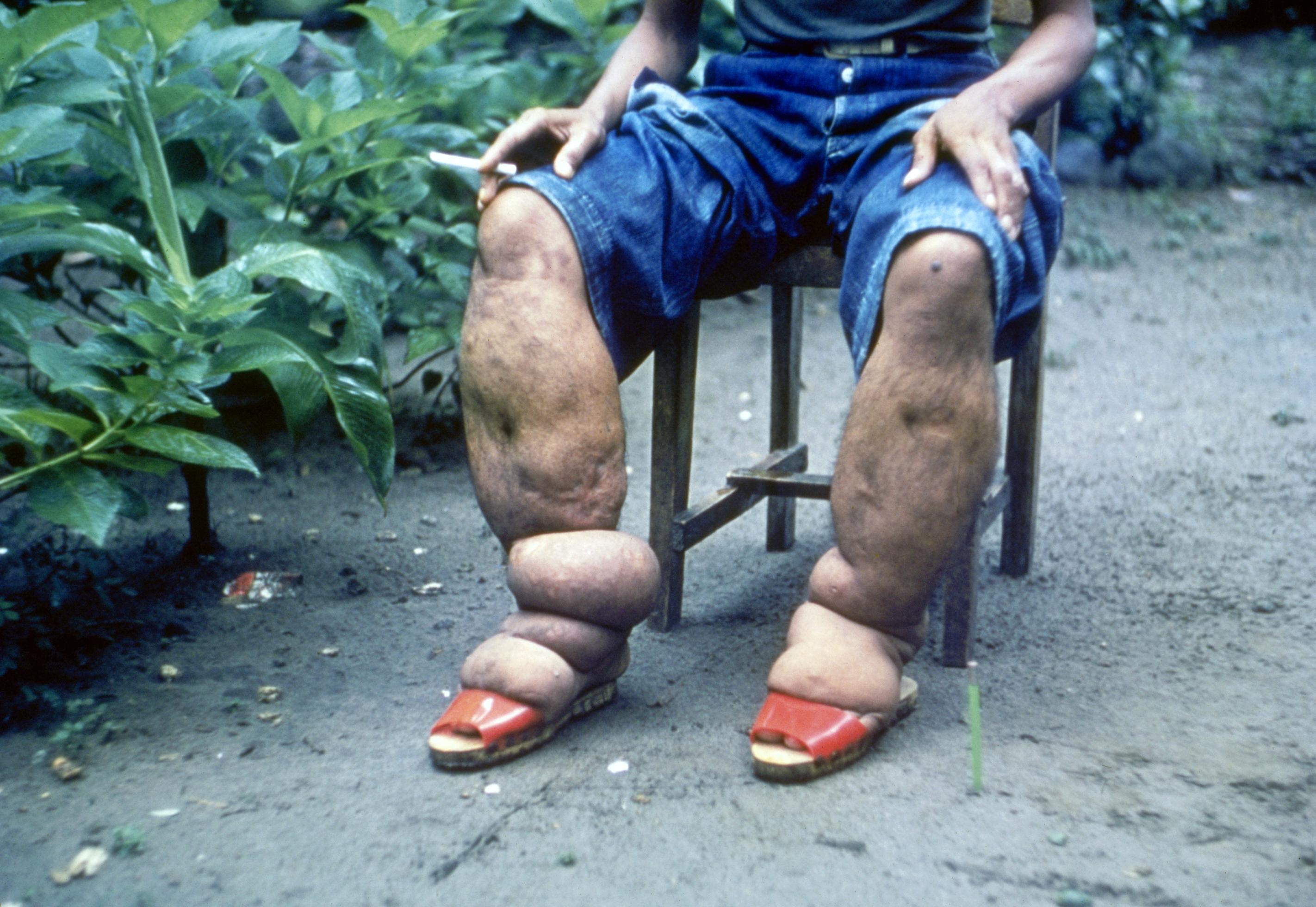 <p>caused by repeated exposure to <em>Wuchereria </em>or <em>Brugia</em> infection, an excessive growth of connective tissue and enormouse swelling of affected parts</p>
