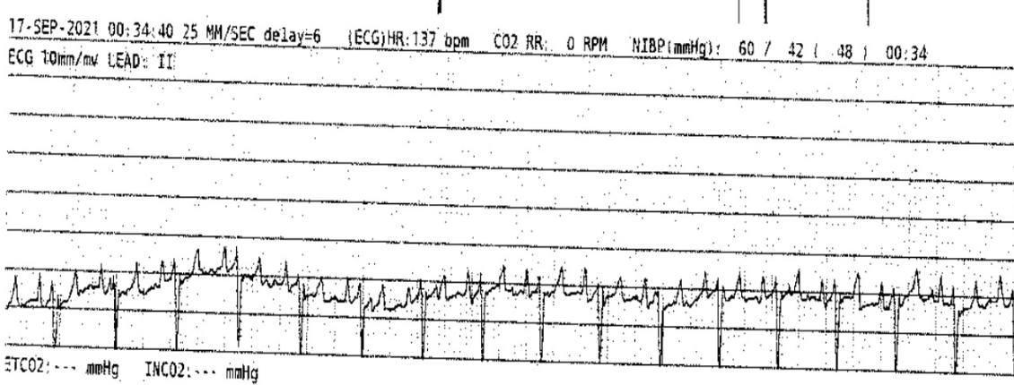 <p>What side of the heart is affected?</p>