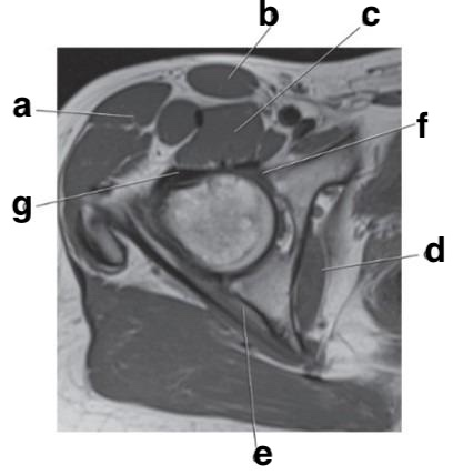 <p>Which letter is the Anterior acetabular labrum?</p>