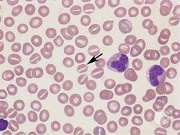 <p>Identify this type of red cell.</p>