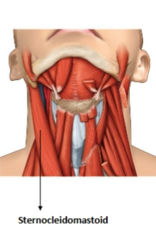 <p>sternocleidomastoid </p>