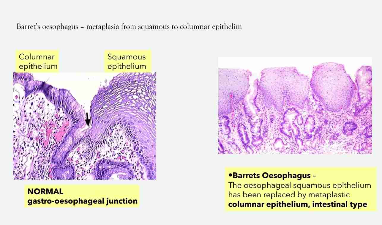 <ul><li><p>Replacement of one differentiated (adult) cell type by other</p></li></ul><ol><li><p>Fully reversible:</p></li></ol><ul><li><p>Reprogramming: STEM cell in epthelia/mesenchymal cell in connective tissue </p></li><li><p>Signals from cytokine, growth factors &amp; Extracellular matrix </p></li><li><p>Loss of normal function/protection </p></li><li><p>If persistent, cause malignancy </p></li></ul><ol start="2"><li><p>Squamous Metaplasia </p></li></ol><ul><li><p>Cervix: squamocolumnar junction - replacement of columnar epithelium by squamous epithelium (physiologic)</p></li><li><p>Occur in respiratory epithelium of bronchus (smoking), endometrium (chronic irritation)&amp; pancreatic ducts (stones)</p></li><li><p>Associated with long term irritation (smoking) &amp; Vit A deficiency </p></li><li><p>Often reversible </p></li></ul>