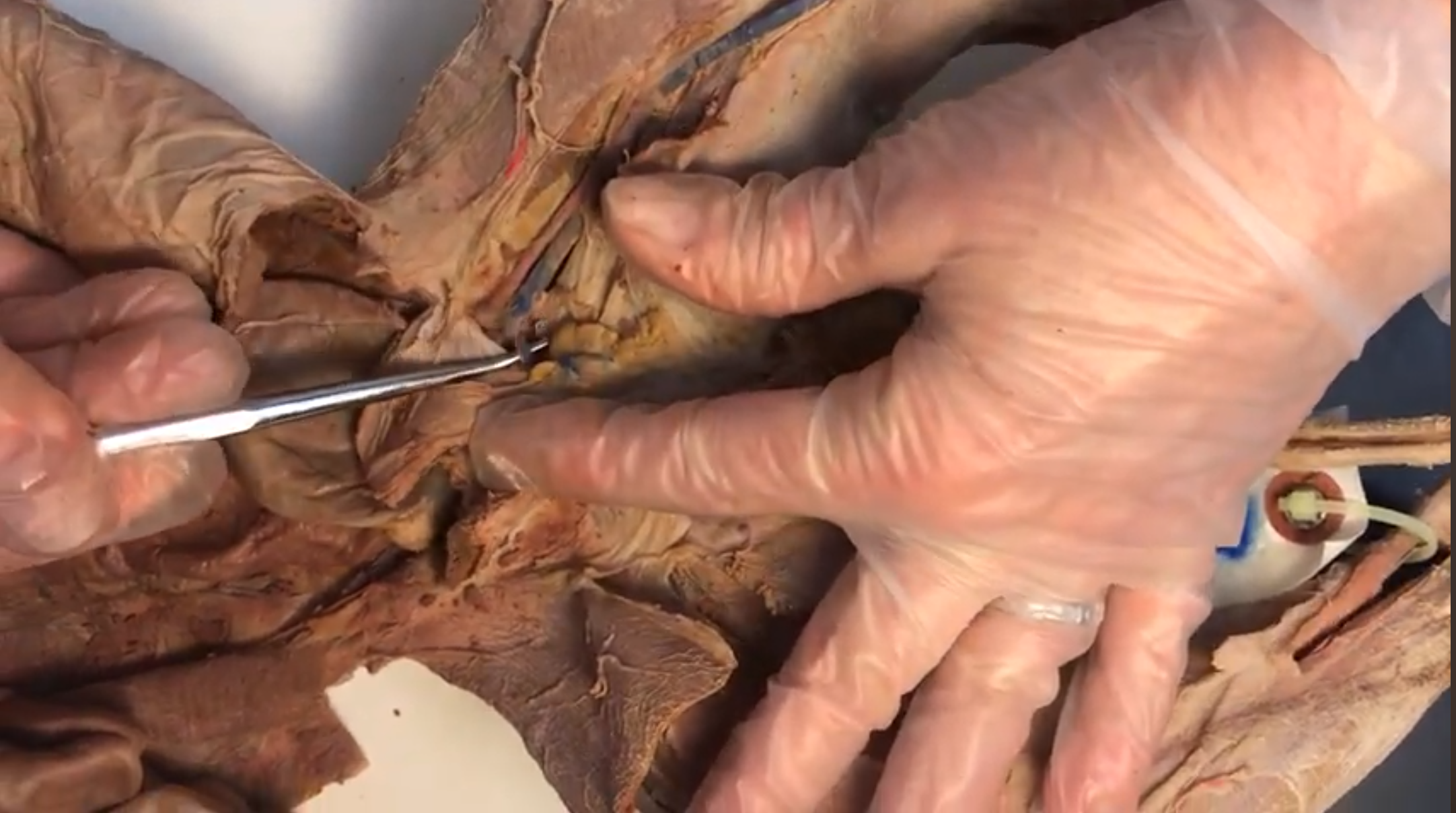 <p>What vein is this</p>