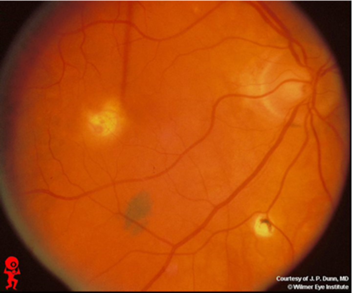 <p>multifocal, bilateral chorioretinitis</p>